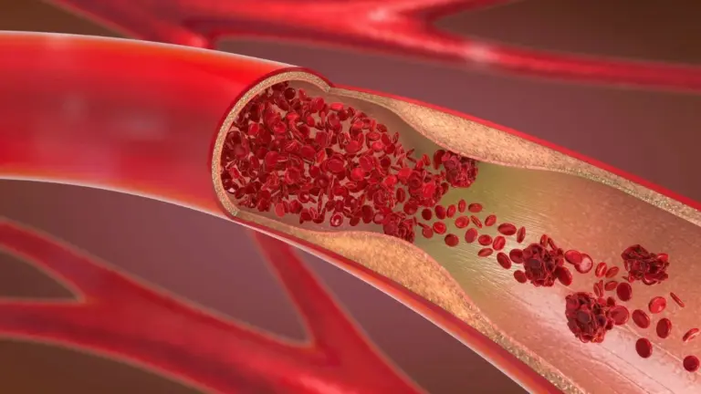 Colesterolo "residuo" ridotto di oltre il 60% con nuovo farmaco: una speranza per il cuore