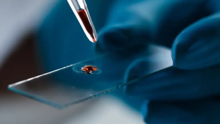 In Italia, il "orologio molecolare" nel sangue predice l'Alzheimer anni prima: ecco come funziona