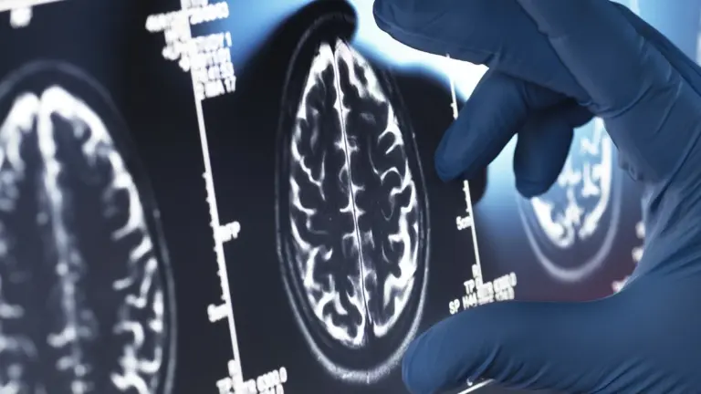 Viagra e Alzheimer: la sorprendente nuova speranza dalla scienza